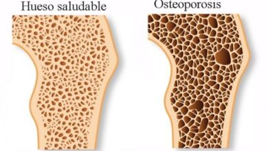 Cada tres segundos se registra una fractura de cadera o alguna extremidad asociada a la osteoporosis