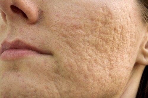 Mal uso de cubrebocas, puede causar enfermedades en la piel