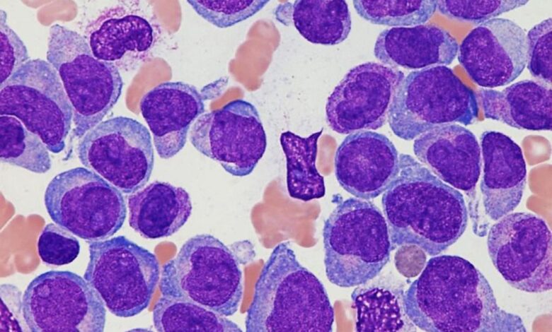 Leucemia mieloide afecta a 5 mil jóvenes al año