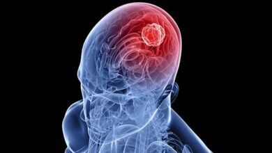 Esto es lo que debes saber de los tumores cerebrales