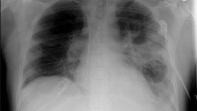 Piden no olvidar a tuberculosis como factor de riesgo para salud