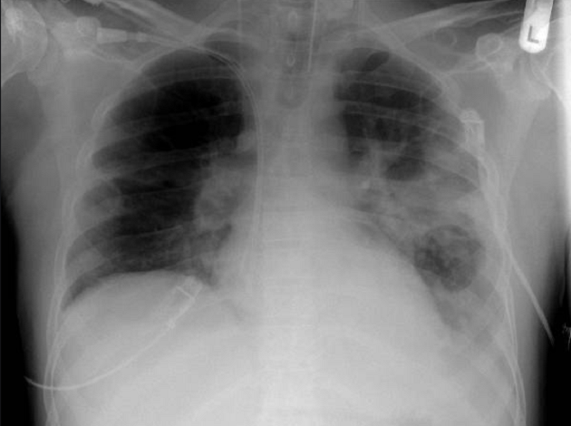 Piden no olvidar a tuberculosis como factor de riesgo para salud