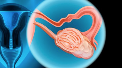 Falta de detección de cáncer de ovario reduce tasa de supervivencia