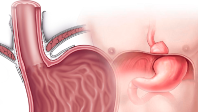 ¿Qué es la hernia de hiato?