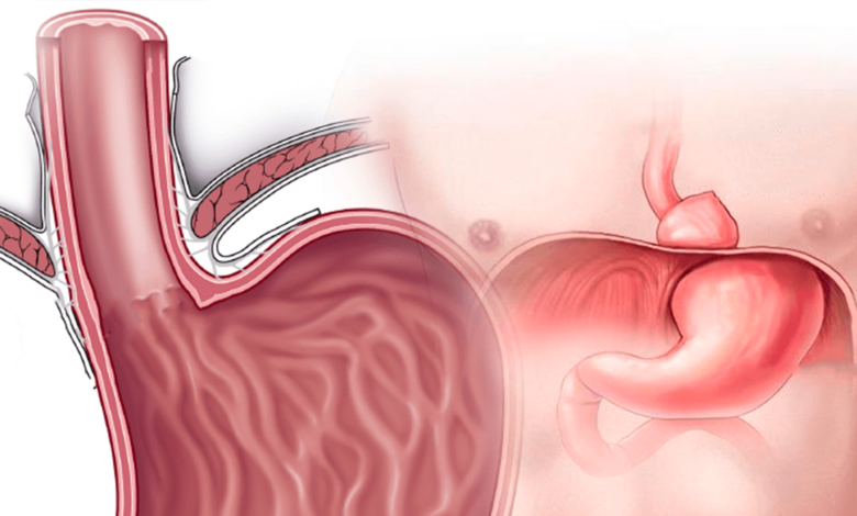 ¿Qué es la hernia de hiato?