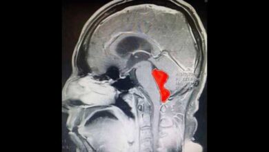 Le extirpan lombriz que vivió 10 años en su cerebro