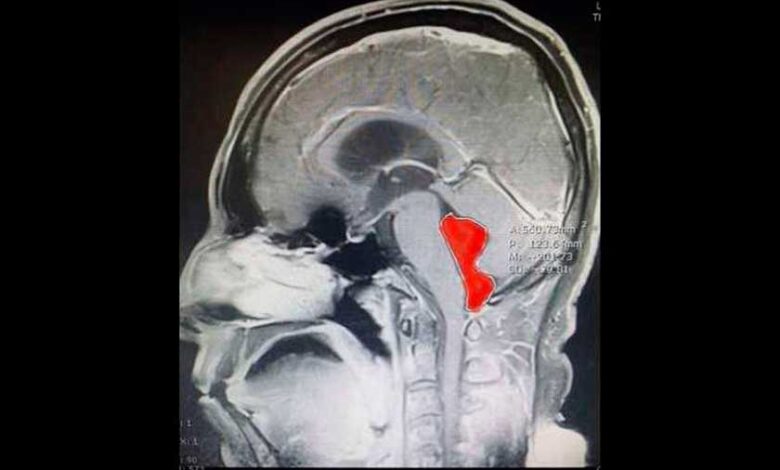 Le extirpan lombriz que vivió 10 años en su cerebro