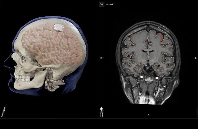 Elon Musk anuncia que su compañía Neuralink ha implantado por primera vez un chip en un cerebro humano