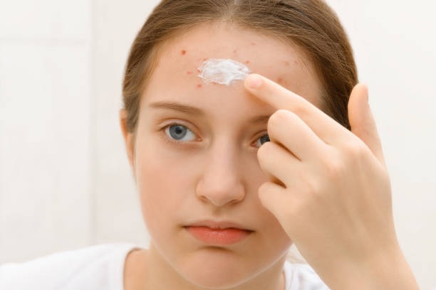 Encuentran sustancia cancerígena en productos para el acné